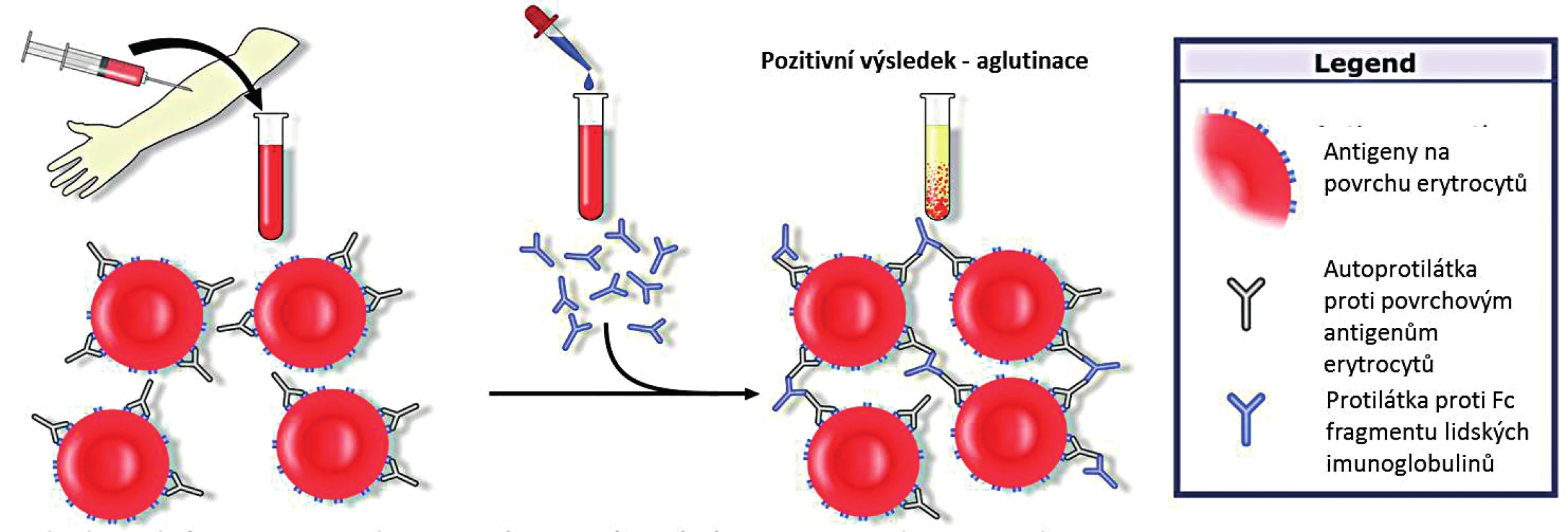 Přímý (Coombsův) aglutinační test (upraveno; GNU Free Documentation License, Wikimedia Commons)