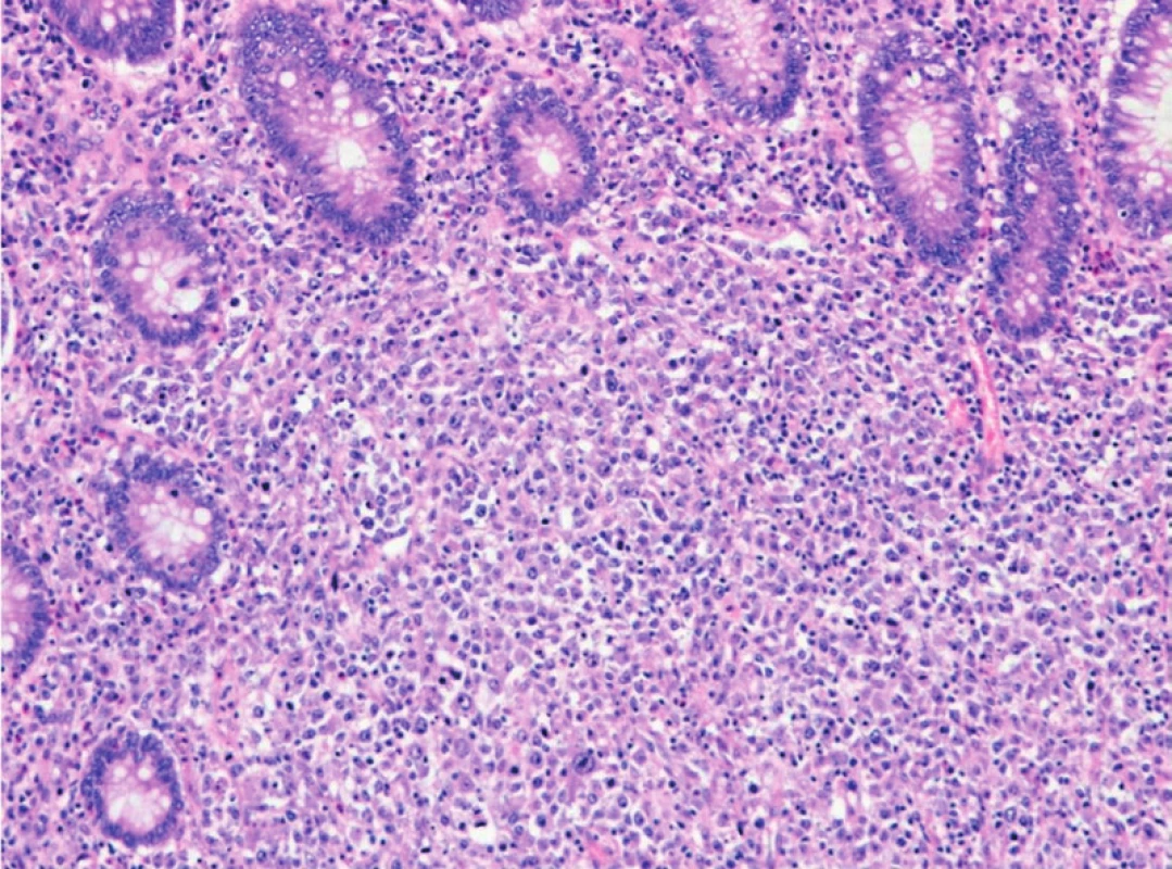 DLBCL ve stěně tlustého střeva, difuzní infiltrace sliznice a submukózy objemnými lymfoidními buňkami (hematoxylineosin, zvětšení 100x).
