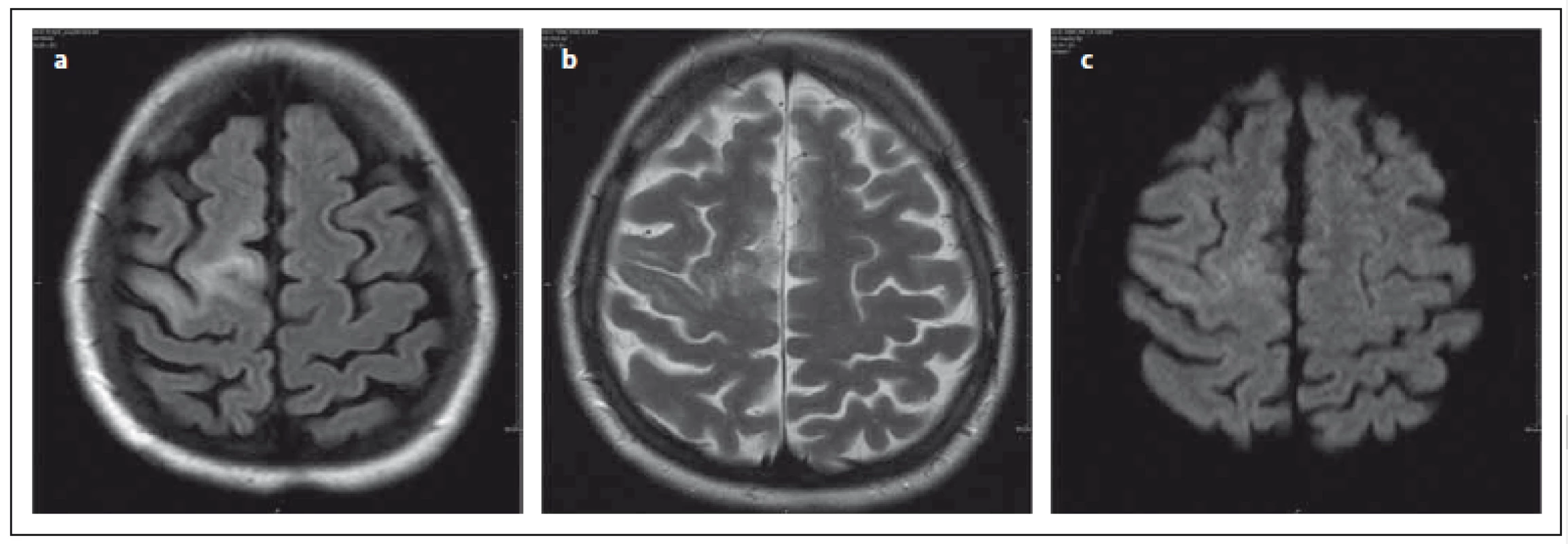 Stejný pacient jako na obr. 1., vyšetření za 2,5 měsíce.
Fig. 2. The same patient as in Fig. 1, examination 2.5 months later.