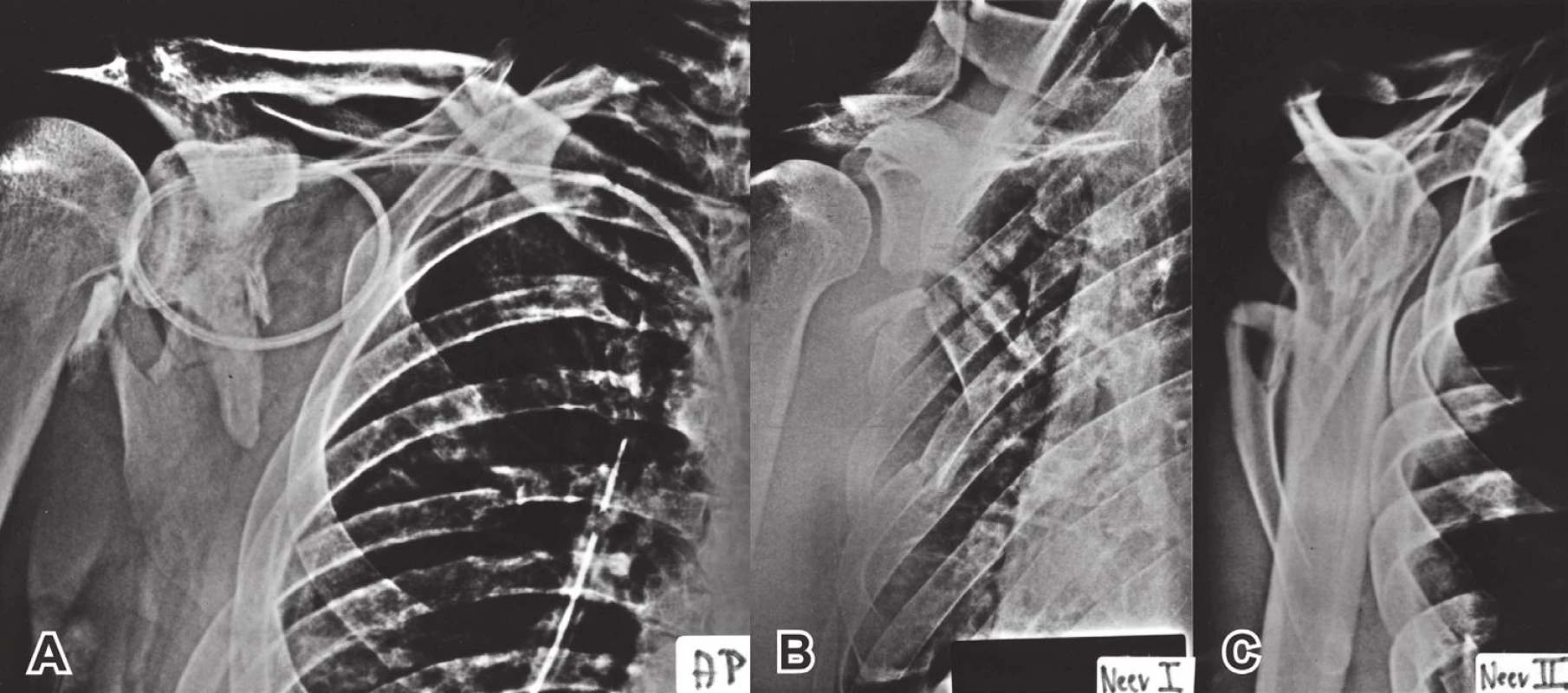 Radiologické vyšetření lopatky: A – předozadní snímek ramenního kloubu; B – Neerova I. projekce (je přesně zobrazena kloubní štěrbina); C – Neerova II neboli Y-projekce.
Fig. 3: Radiologic examination of scapula: A – anteroposterior view of the shoulder; B – Neer I view (showing clearly the joint line); C – Neer II view or Y-view.