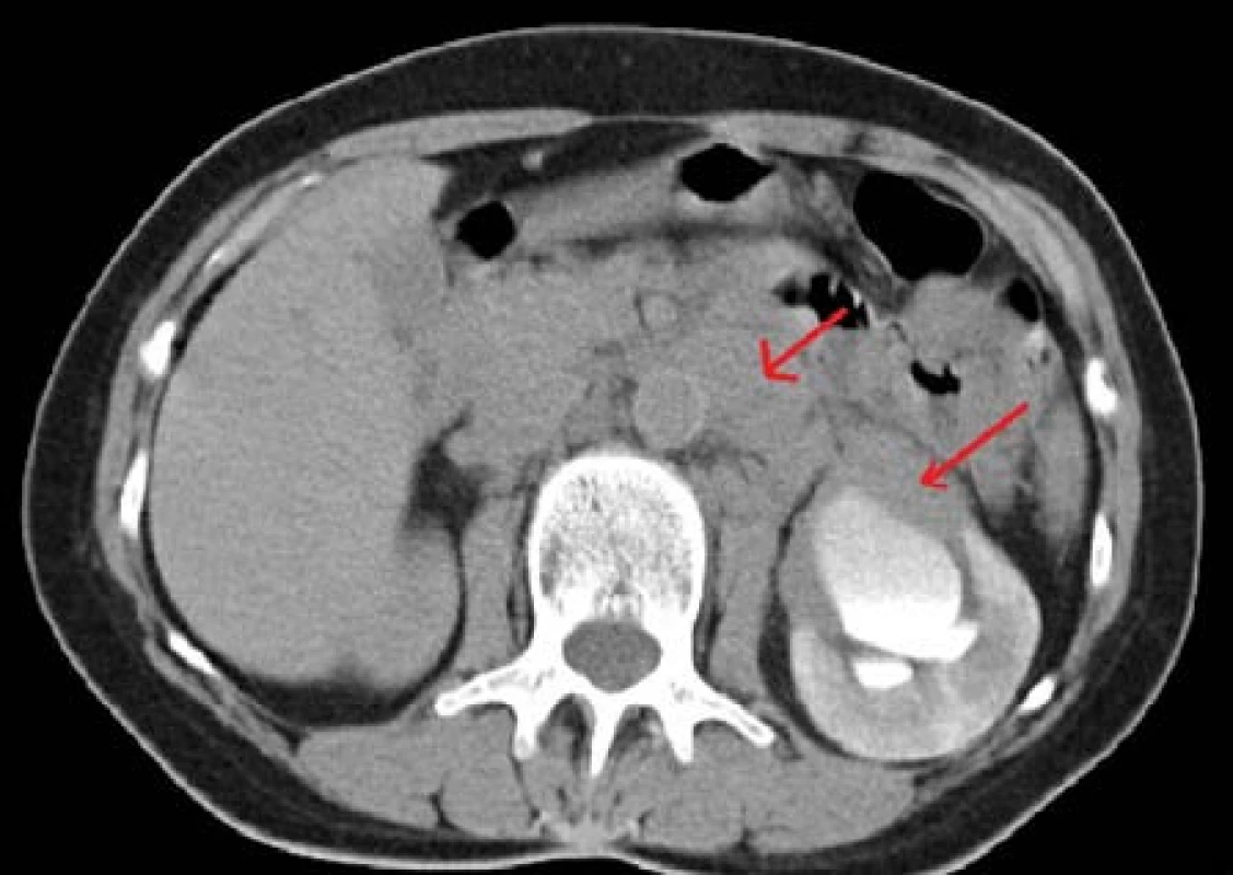 CT-vylučovací urografie s expanzivně se chovající masou cirkulárně obklopující ledvinnou pánvičku a proximální močovod vlevo, další masa paraaortálně v levém retroperitoneu. Folikulární lymfom
Fig. 3. CT-urography – mass surrounding left renal pelvis and ureter, another mass in left retroperitoneal paraaortic region. Follicular lymphoma