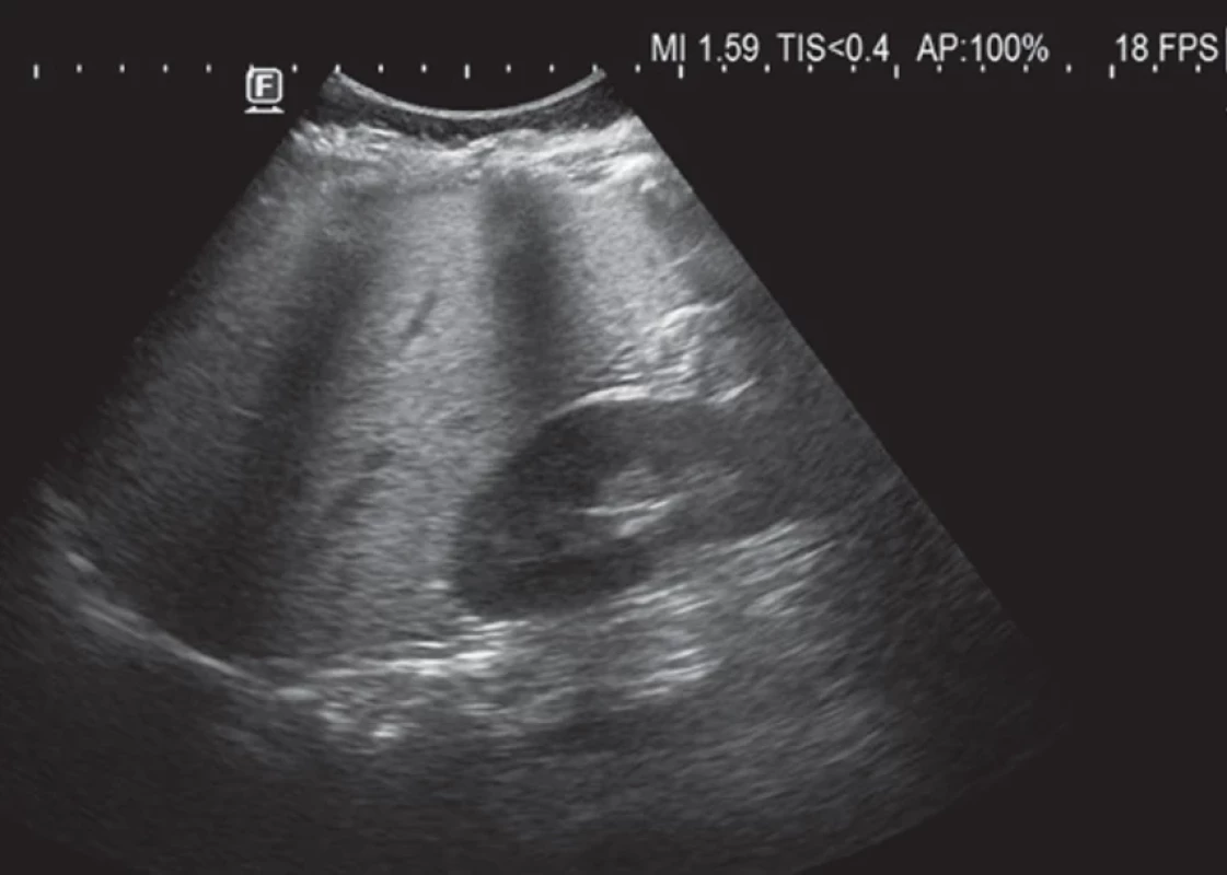 Sonografický nález pri príjme – významná hepatomegália (22 cm, norma vzhľadom k veku do 14,5 cm) s hepatopatiou  v zmysle signifikantnej steatózy stredného stupňa – HR index 1,9  (histologicky postihnutých 25 – 60 % hepatocytov)