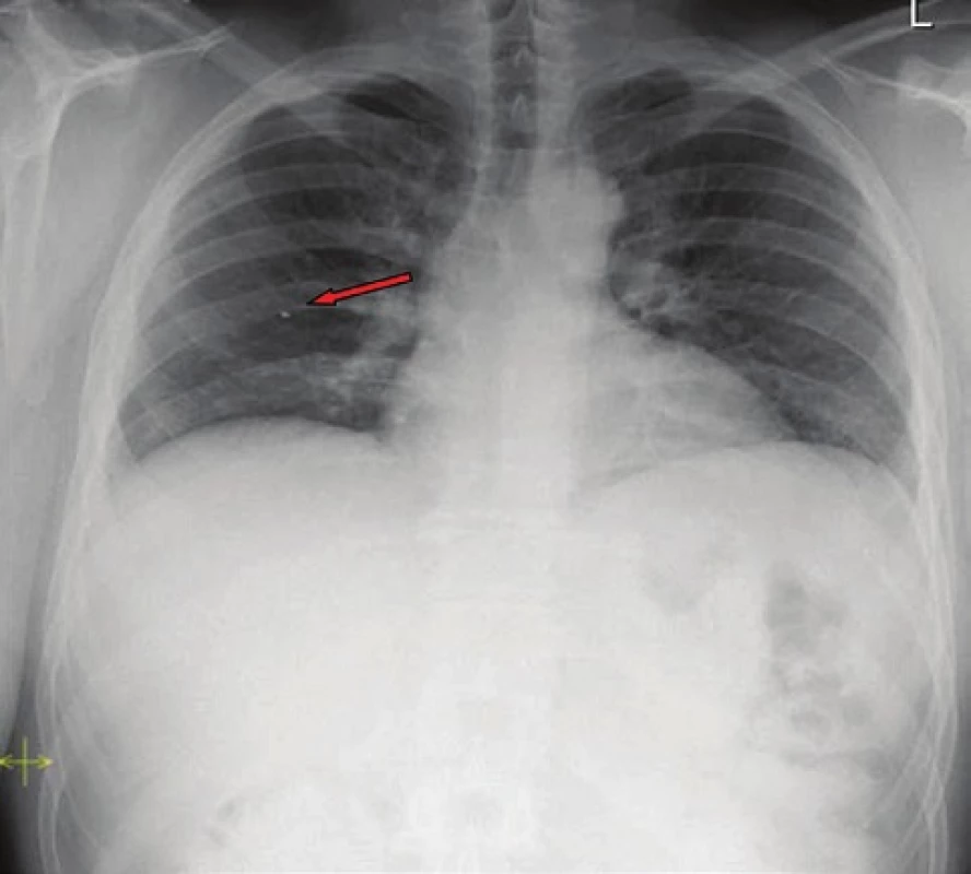 Kontrolní RTG hrudníku po roce: hyperdenzní struktura v oblasti pravého plicního pole
Fig. 3 : Check-up chest X-ray after one year period: hyperdense structure in the area located of the right pulmonary field