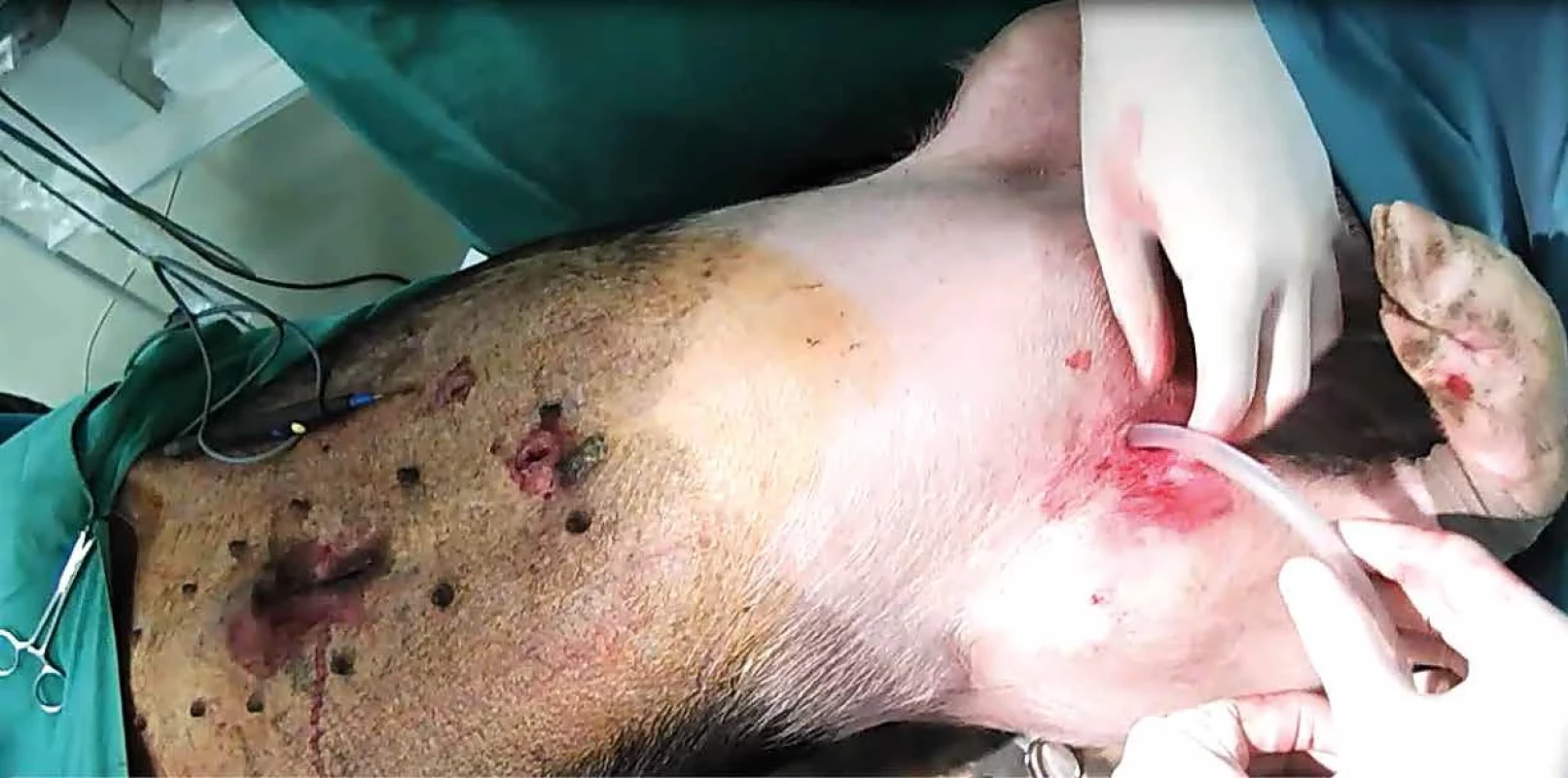 Hrudní drenáž   Fig. 3: Chest drainage