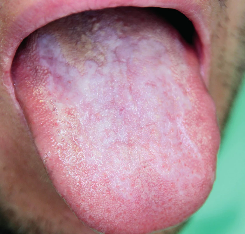 Orální lichen planus – plakovitá forma