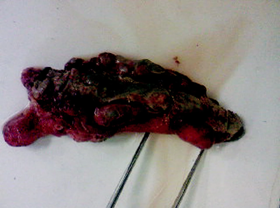 Gangrenózny apendix s divertikulózou, divertikulitídou a perforáciou na apexe apendixu vermiformis
Pic. 2. Gangrenous appendix with diverticulosis, diverticulitis and perforation of the appendix vermiformis apex