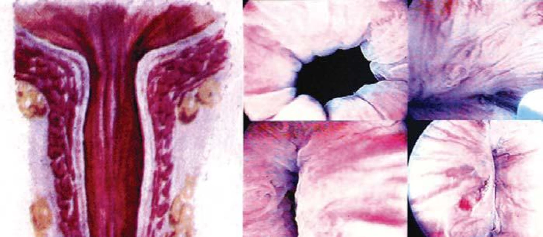 Chondrocyty jsou odebrány a smíchány s alginátem in vitro, suspenze aplikována pomocí cystoskopické injekce při léčbě močové inkontinence.
