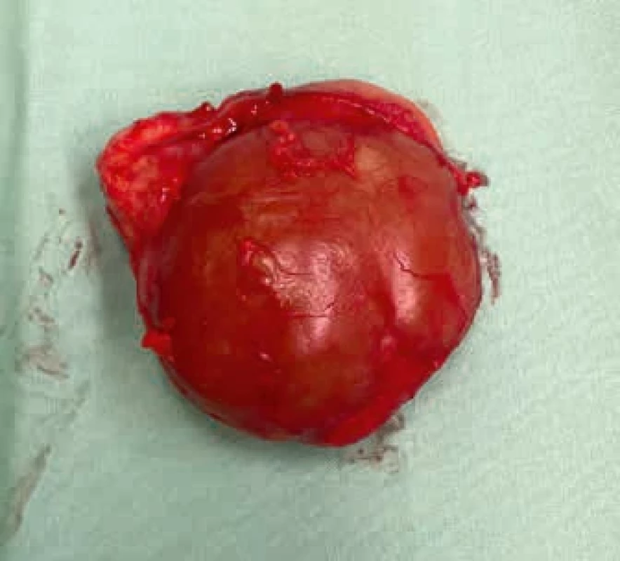 Tumor – extralobární plicní sekvestr.