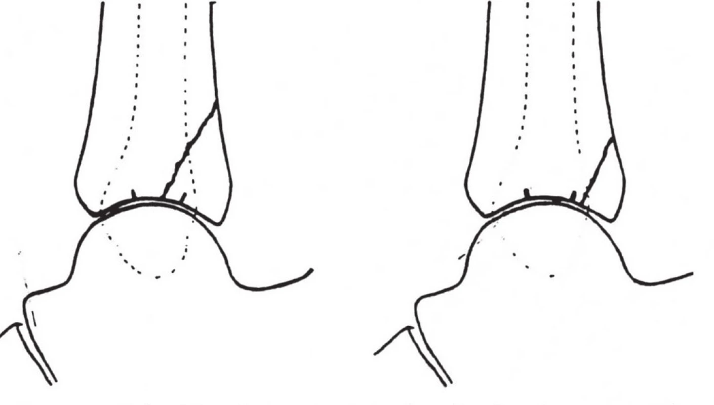 Nelson-Jensenova klasifikace z r. 1940
<i>„Classic fracture“</i>postihující více než třetinu kloubní plochy a <i>„minimal fracture“</i>. Převzato z [24].
Fig. 3: Nelson-Jensen classification published in 1940
<i>“Classic fracture”</i> involved more than one third of articular surface and <i>“minimal fracture”</i>. Adapted from [24].