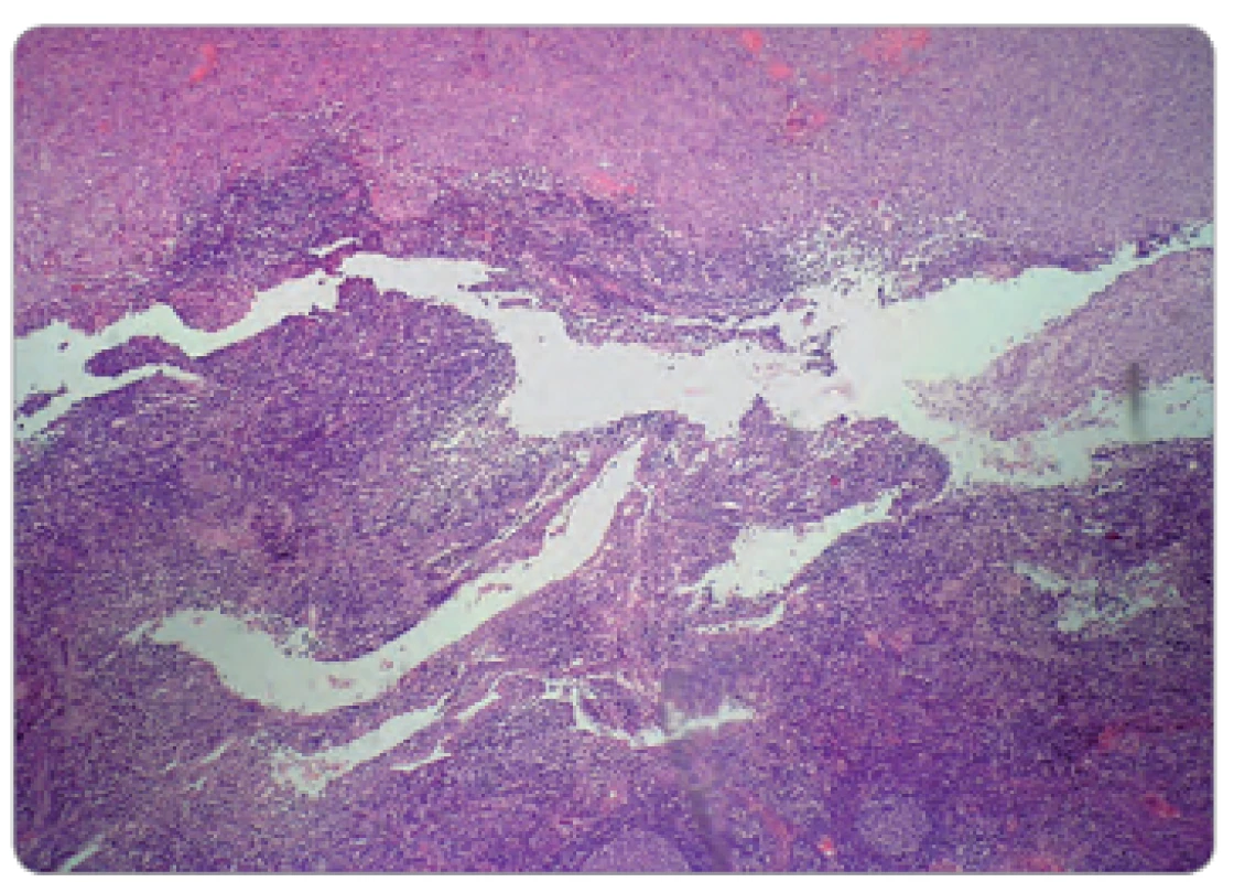 Infi ltrácia inguinálnej lymfatickej uzliny spinocelulárnym karcinómom. Histologický nález, farbenie HE.