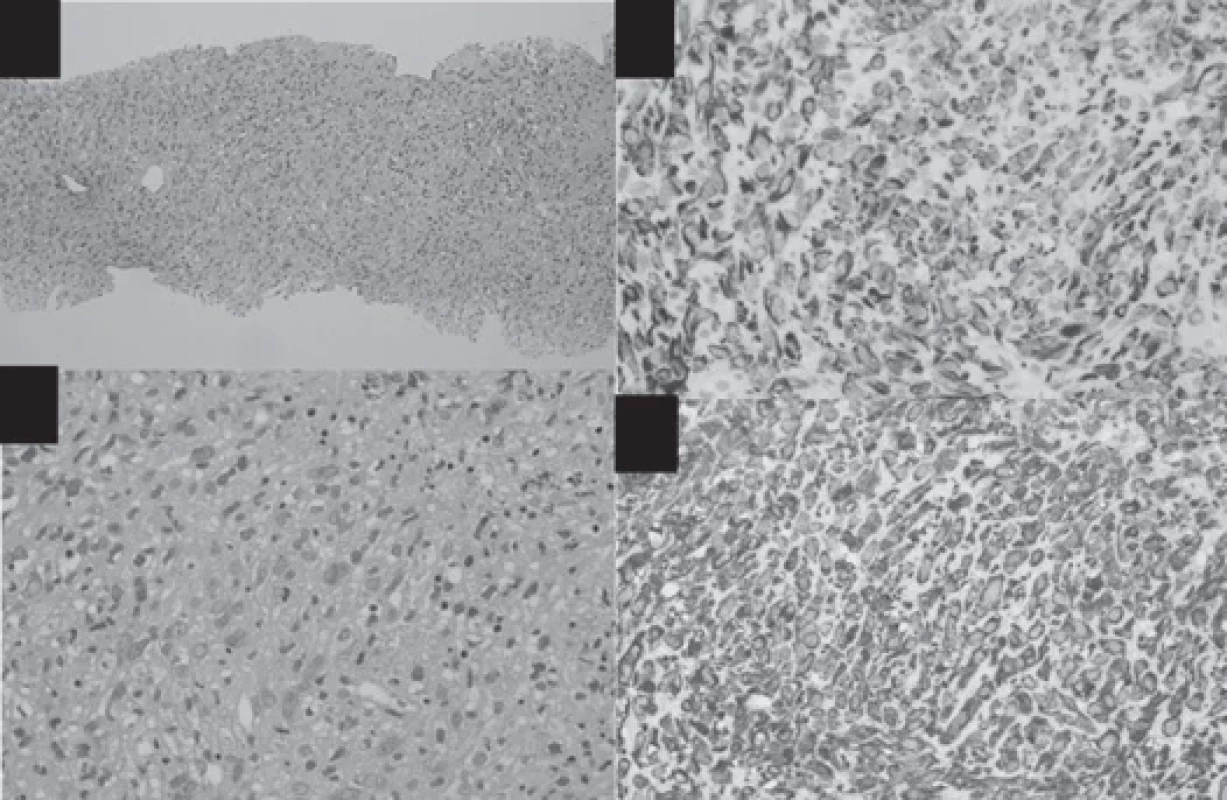 Hematoxylin and eosin staining of the tissue obtained by percutaneous biopsy – low power (A), high power (B) – showed that
the tumor cells had no clear morphological tendency to diff erentiate, being extremely undiff erentiated. The fi nding was considered
to be a malignant undiff erentiated tumor, most likely an undiff erentiated carcinoma. Immunostaining showed that CK7 was focally
positive (C), and vimentin was positive (D).
