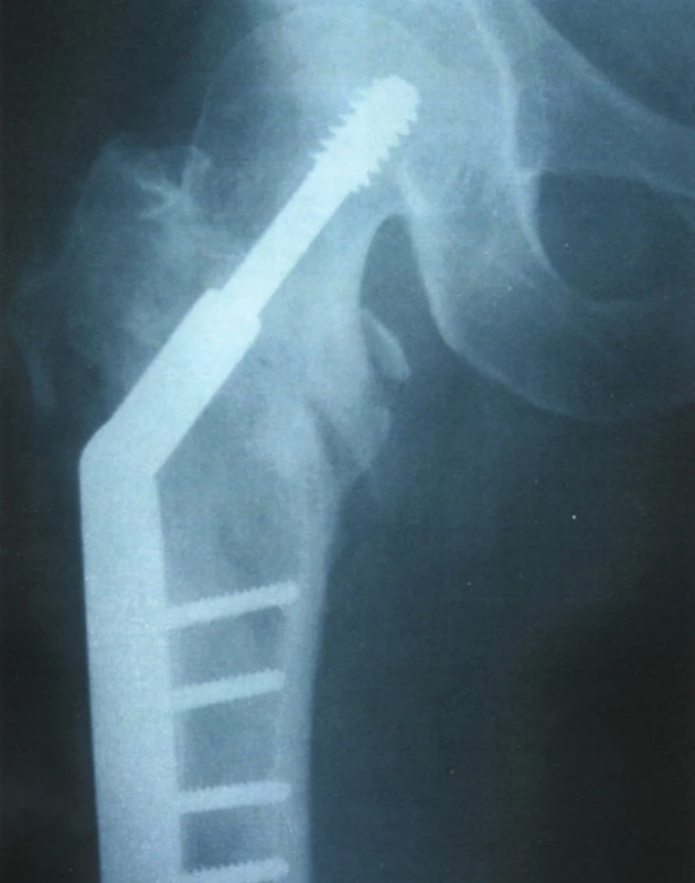 Pertrochanterická zlomenina stehenní kosti z obrázku 3 léčena osteosyntézou
Fig. 4. The pertrochanteric femoral fracture depicted on Fig. 3, managed by osteosynthesis