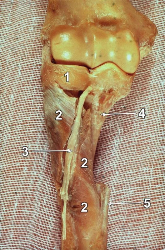 Průběh r. profundus n. radialis při pronaci předloktí: Je patrné, že nerv probíhá po přední ploše pronovaného radia, úpon m. pronator teres se přesunul mediálně. Proto je nutná při preparaci během operace maximální supinace proximálního úlomku radia. 
1 – lig. anulare radii, 2 – m. supinator s vypreparovaným průběhem r. profundus n. radialis, 3 – r. profundus n. radialis, 4 – šlacha m. biceps brachii, 5 – úpon m. pronator teres.
Fig. 10: The course of the deep branch of radial nerve in pronated forearm: The nerve passes over the anterior surface of the pronated radius, insertion of the pronator teres moved medially. Therefore maximum supination of the proximal fragment of radius is required during intraoperative dissection. 
1 – radial annular ligament, 2 – supinator with dissected course of the deep branch of radial nerve, 
3  – deep branch of radial nerve, 4 – biceps brachii tendon, 5 – insertion of the pronator teres.