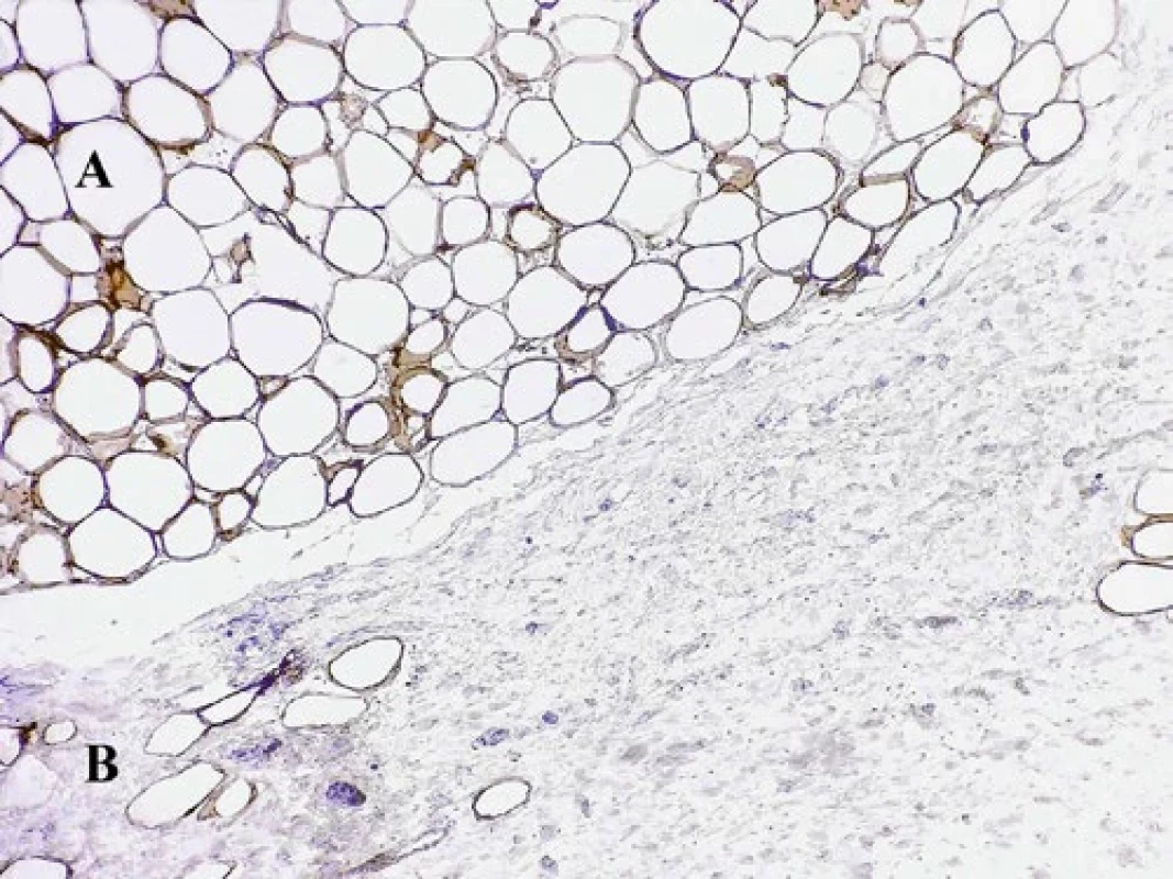 Imunohistochemický dôkaz expresie S100. Vretenobunkový lipóm (B) je negatívny, zatiaľ čo klasický lipóm (A) je pozitívny. (objektív 20×)