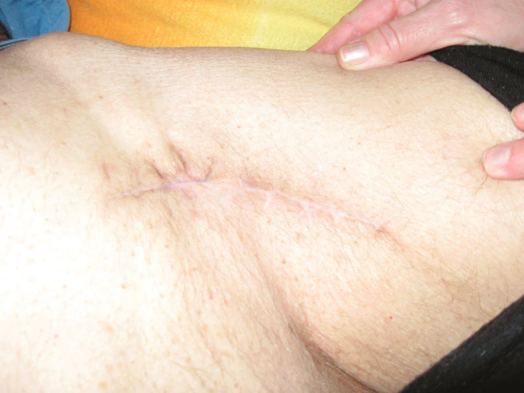 Stav po zhojení
Fig. 11. Result after the wound healing