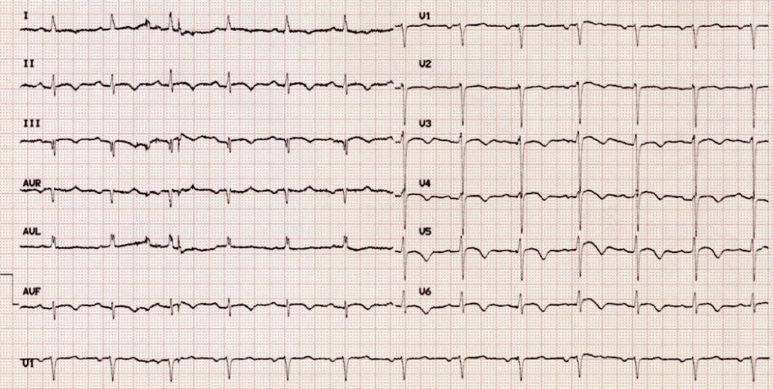 EKG pacientky při propuštění