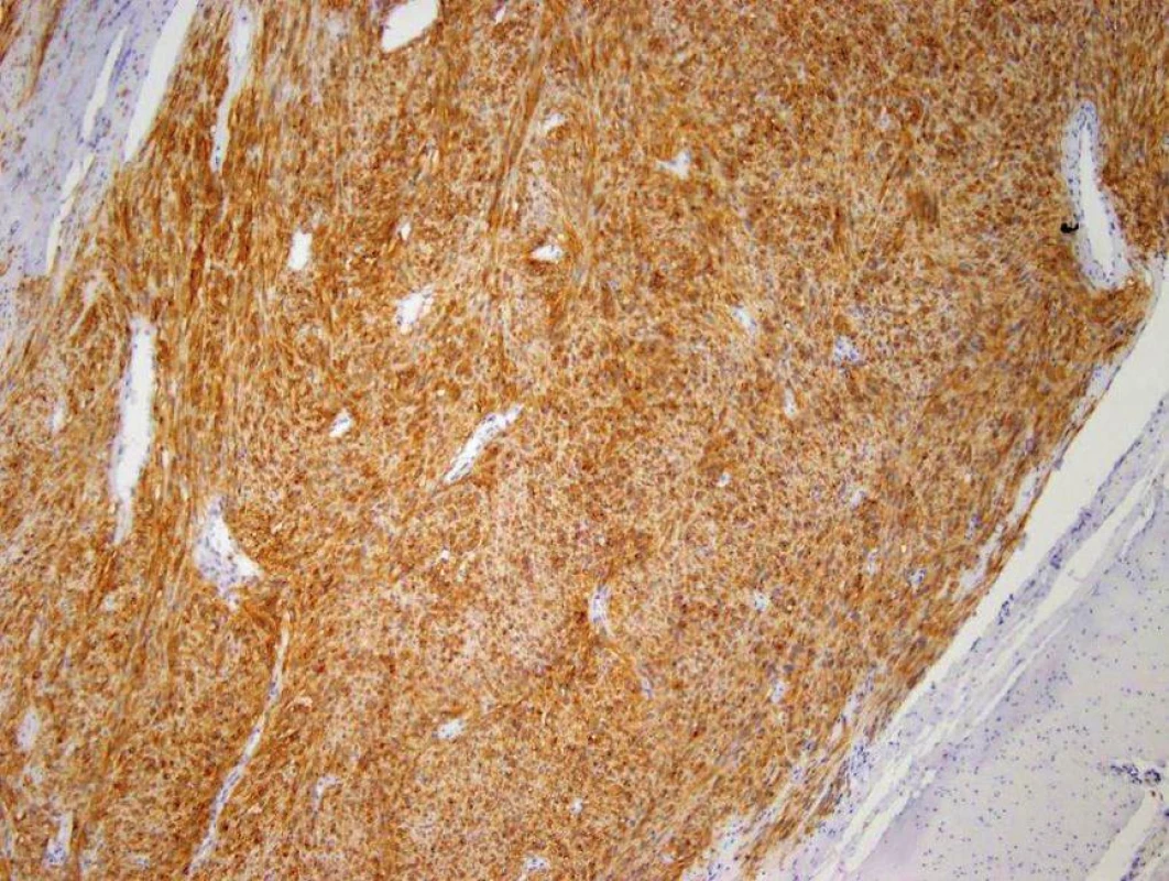Imunohistochemické vyšetření protilátkou CD117 – pozitivita (hnědé zbarvení) je jednoznačné kritérium diagnózy GIST
Fig. 3: CD117 antibody immunohistochemistry − positivity (brown staining) is an unambiguous criterion for the diagnosis of GIST