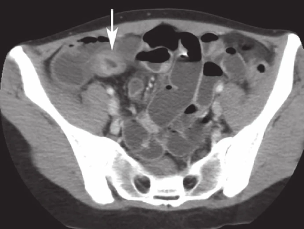CT-enteroklýza s vyznačeným nálezom infiltrátu terminálneho ilea.
Fig. 1. CT enteroclysis with marked infiltration of the terminal ileum.