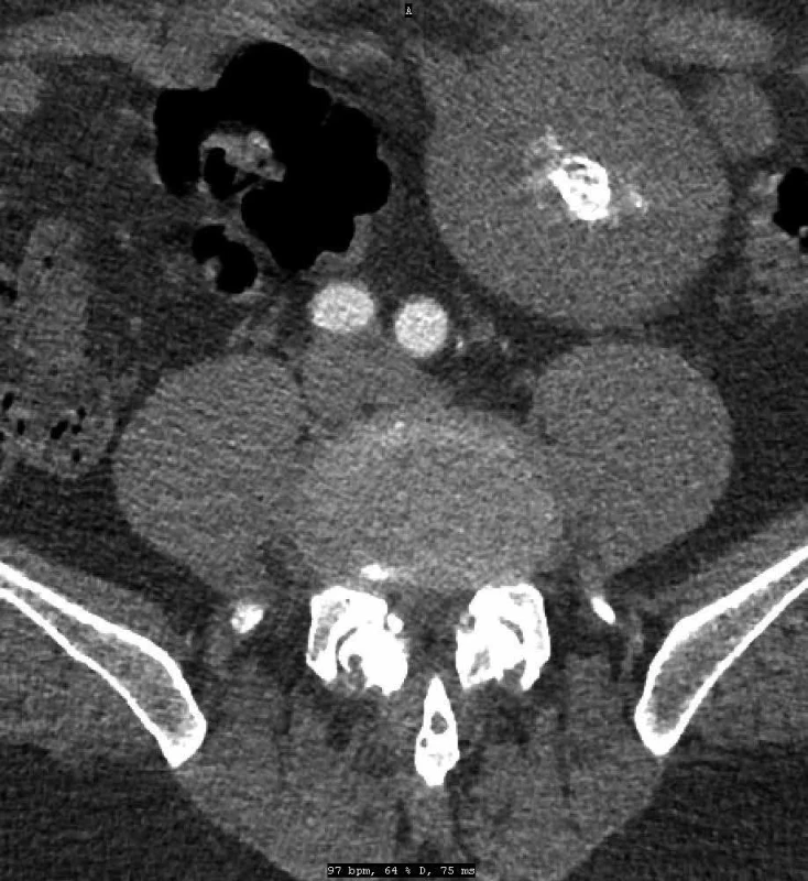 Na CT detekovaná rezistence levého hypogastria s centrální nekrózou Fig. 1: Resistance of the left hypogastrium with central necrosis was detected on CT