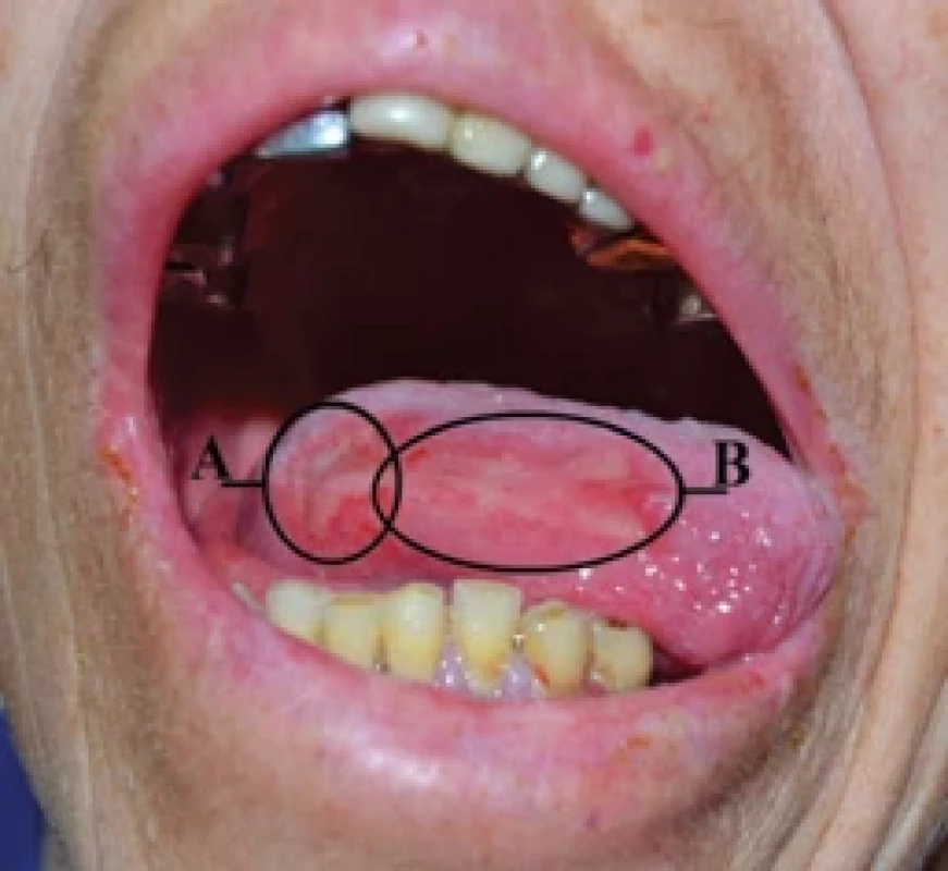 Endophytic tumour of the lateral surface of the tongue on the right (A); erosion of the lateral surface of the tongue without ulceration and bleeding – grade III radiation mucositis (B).