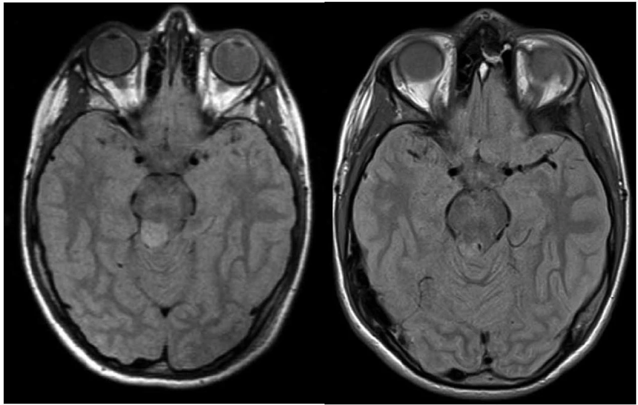 Vlevo: 10letý pacient se stereobiopticky verifikovaným astrocytomem stupeň I, velikost nádorového objemu
1 500 mm<sup>3</sup>, minimální aplikovaná dávka 25 Gy v 5denních frakcích; vpravo: kontrolní vyšetření magnetickou rezonancí za čtyři roky, bez známek pozdní toxicity.