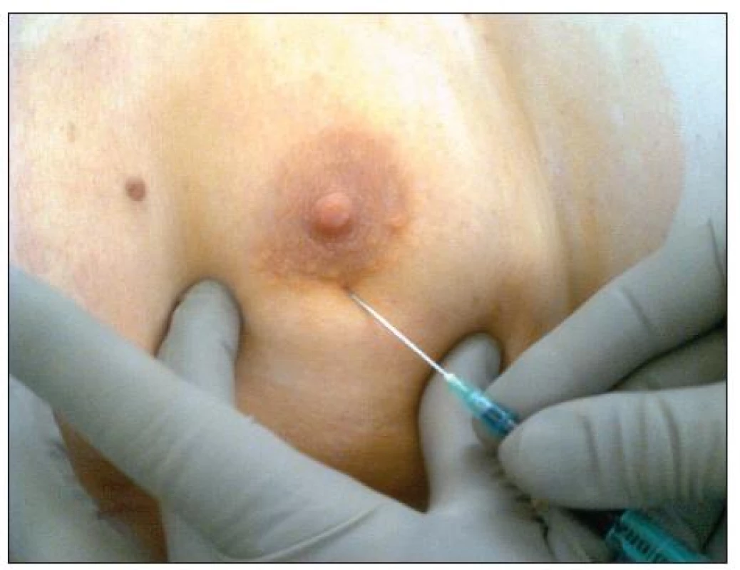 Aplikácia Bleu-Patenté subareolárne
Fig. 3. Administration of Bleu-Patenté under the areola