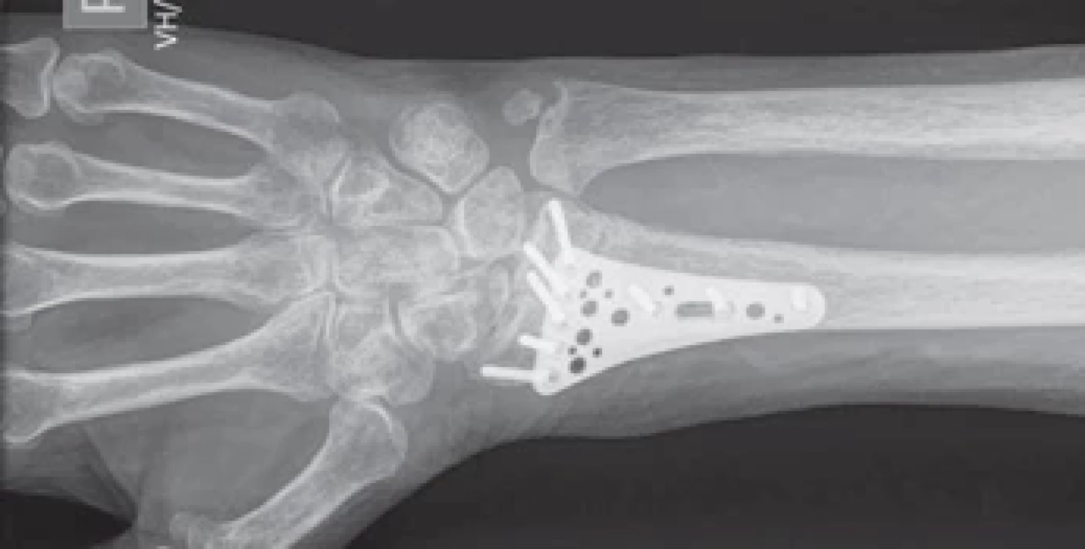 Rentgenologický snímek pravého zápěstí po dlahové osteosyntéze pravého distálního radia.</br> Fig. 5. X-ray of the right wrist after splint osteosynthesis of the right distal radius fracture.
