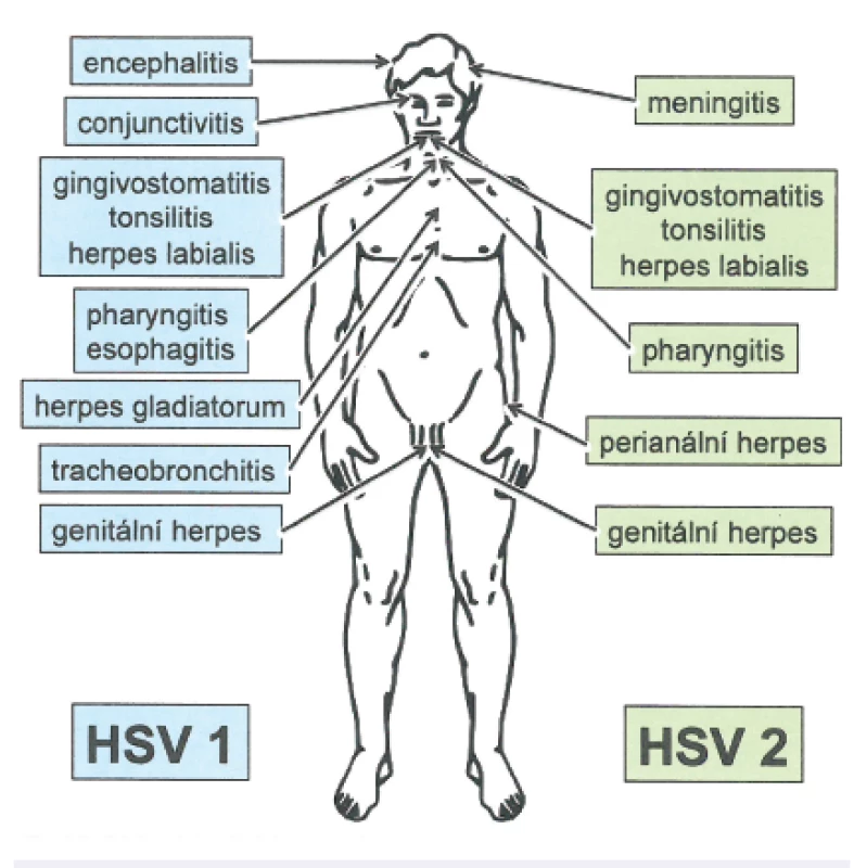 Schéma jednotlivých možných onemocnění vyvolaných HSV-1 a HSV-2
Fig. 2. Diseases caused by HSV-1 and HSV-2