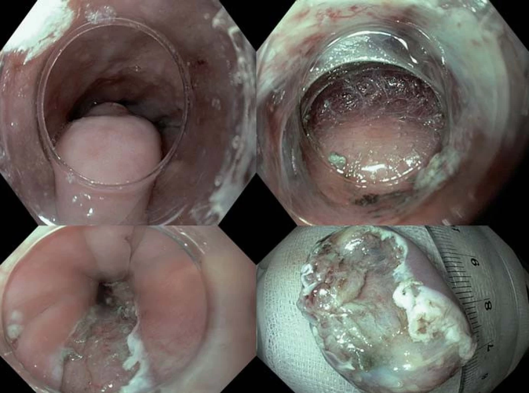 STER velkého (4 cm) symptomatického submukózního nádoru v IKEM.
Fig. 11. STER of a large (4 cm) symptomatic submucosal tumour at the ICEM.
