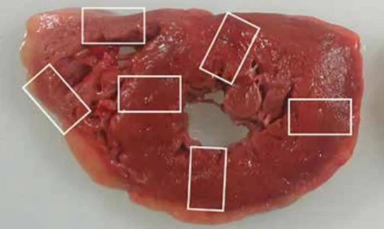 Minimální požadavky na odběr vzorků z nekroptických vzorků nebo explantátů srdce při podezření na myokarditidu. Odebráno by mělo být nejméně šest vzorků komorového myokardu.