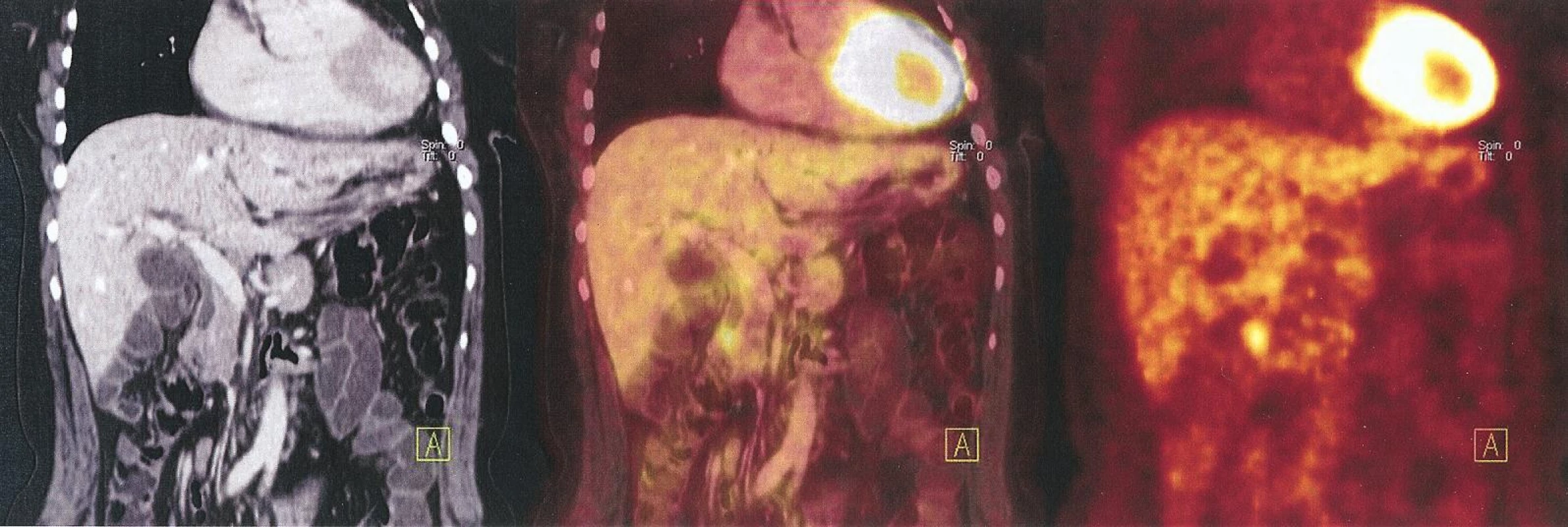 Falešná negativita. Nemocný s karcinomem hlavy pankreatu. CT ani PET/CT nezachytilo malé mnohočetné metastázy jater. Provedena explorace, biopsie z pankreatu a jater, potvrzující karcinom
Fig. 5. False negativity. Patient with pancreatic head cancer. CT or PET/CT did not reflect the multiple small liver metastases. Carried out exploration, biopsy of the pancreas and liver confirmed the cancer