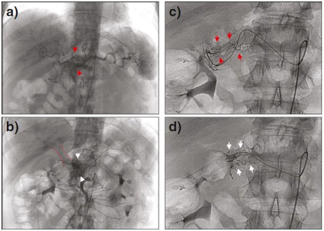 Celiacography and the selective angiography of the upper mesenteric, revealing feeding arteries from a common hepatic artery (a, <i>red arrowheads</i>) and from the initial portion of the upper mesenteric artery (b, <i>white arrowheads</i>), with early visualization of the portal vein in the same phase (<i>encircled in red</i>). Additional vascular network branching from the watershed of the gastroduodenal artery (c, <i>red arrows</i>) and hepatic artery proper (d, <i>white arrows</i>) is also shown