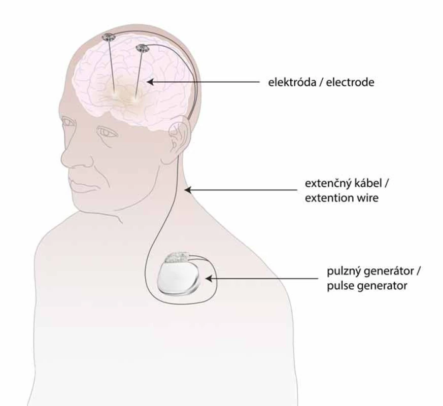 Schéma zapojenia elektród pri hlbokej mozgovej stimulácii (upravené podľa propagačných materiálov Medtronic a Boston Scientific).
Fig. 1. Schedule of conventional deep brain stimulation (modified version of advertising material – Medtronic and Boston Scientific).
