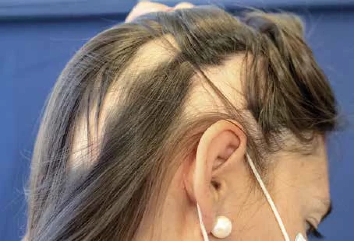 Alopecia areata. [Foto: Z archivu Dermatovenerologické kliniky 2. LF UK a FNB.]