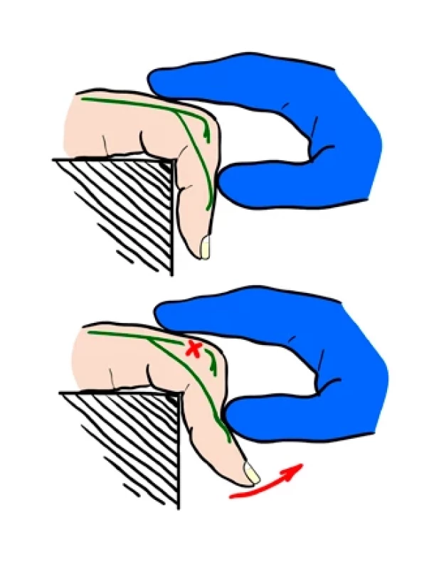 Elsonův test.