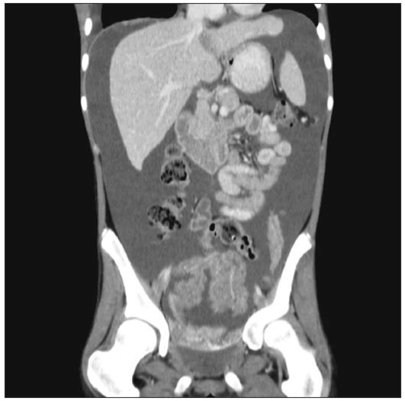 Masivní maligní ascites (snímek CT)
Fig. 2. Massive malignant ascites (CT view)