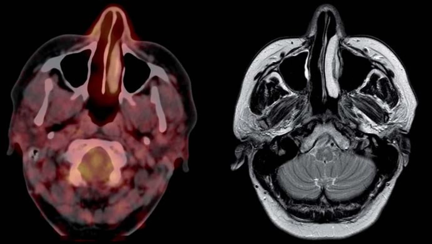 Po operačním zákroku, FDG-PET/CT i MRI vyšetření bez patologického nálezu.