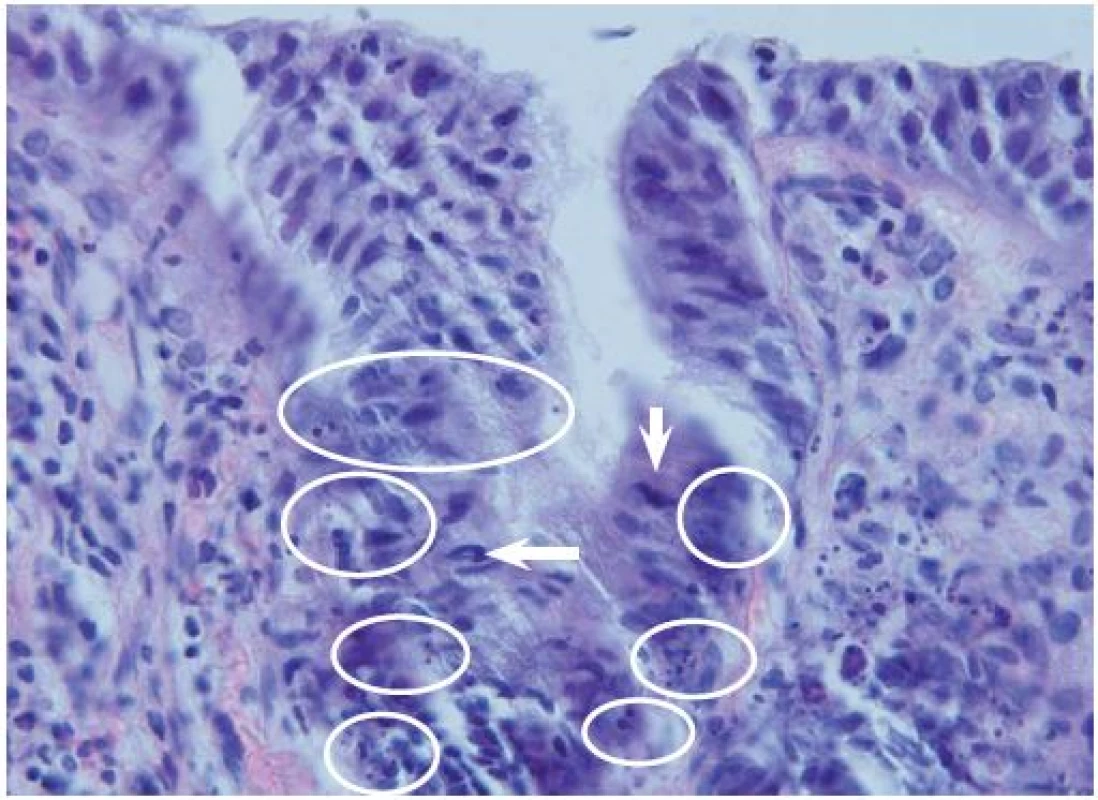 Apoptotická aktivita v horní části krypt pokročilého adenomu – mitotická figura (šipka), apoptotická tělíska (v kroužku). Hematoxylin-eozin, originální zvětšení 600×.
Fig. 3. Apoptotic activity in the upper part of the crypts in advanced adenoma –  mitotic figure (arrow), apoptotic bodies (in circle). Haematoxylin-eosin, original magnification ×600.
