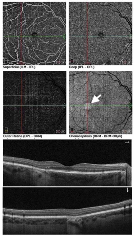 Na OCT angiografií pravého oka má povrchový aj hlboký kapilárny plexus primeranú vaskularitu a vrstva choriokapillaris má z dôvodu atrofie RPE zvýšený signál (biela šípka)
