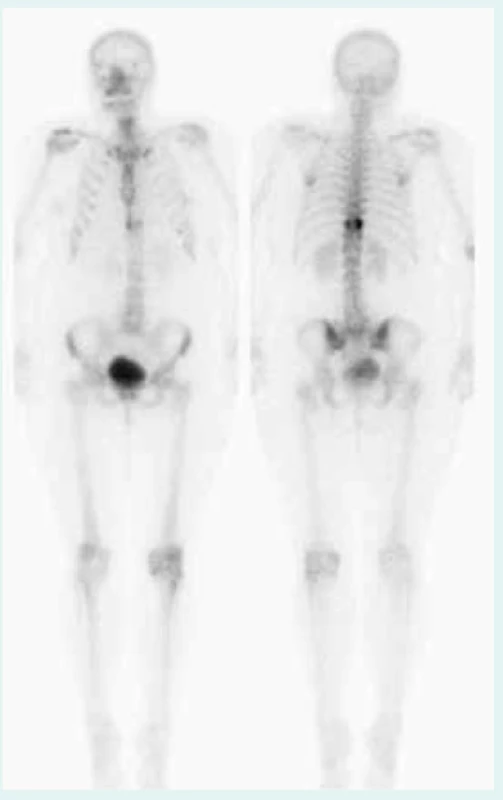 Scintigrafie (září 2012) – solitární metastáza osteolytického charakteru v Th10