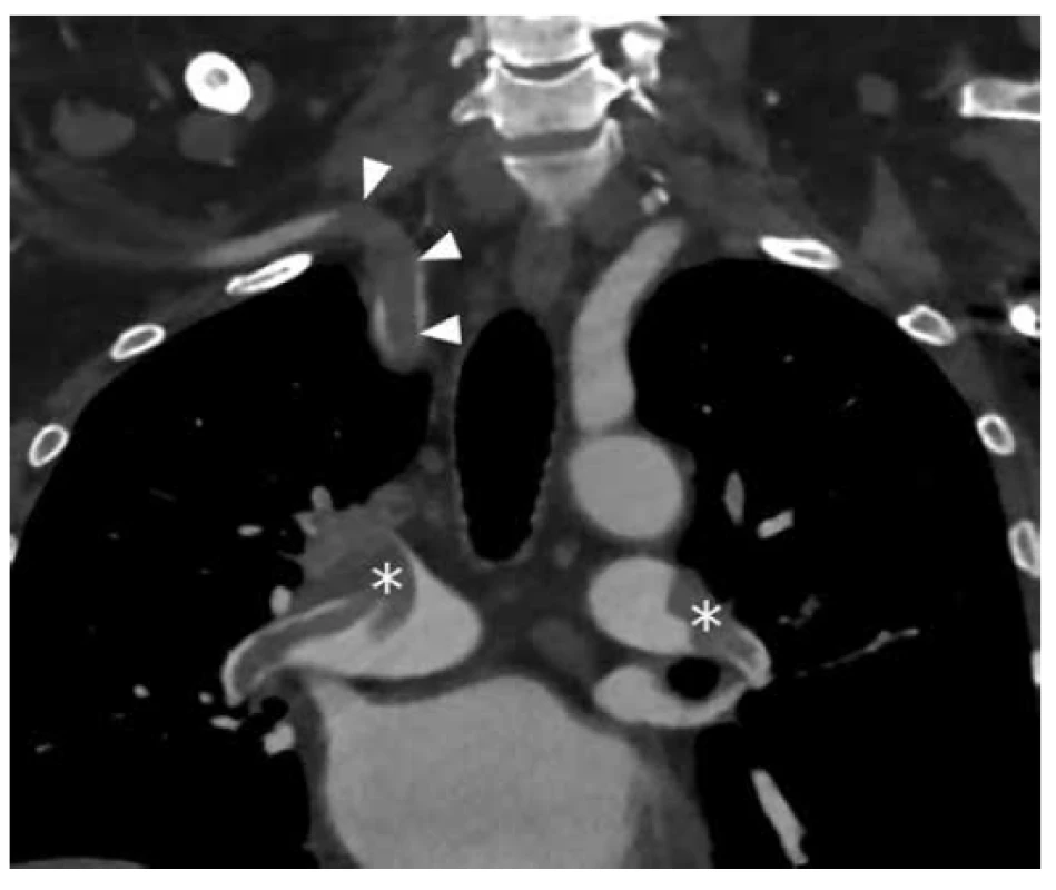 CT vyšetření, šipky – embolus v pravé a. subclavia,
hvězdičky – emboly v a. pulmonalis<br>
Fig. 1: CT scan, arrows – embolus in the right subclavian
artery, asterisks – emboli in pulmonary arteries