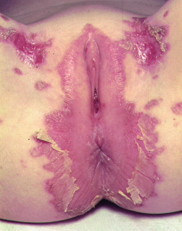 Kožní změny při acrodermatitis enteropathica.