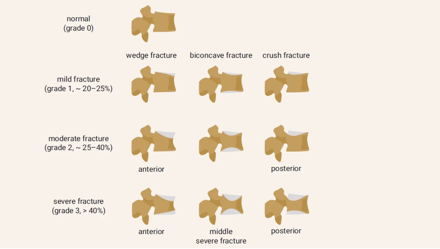 Vertebral fractures semi-quantitative grading. Modified according to [16]