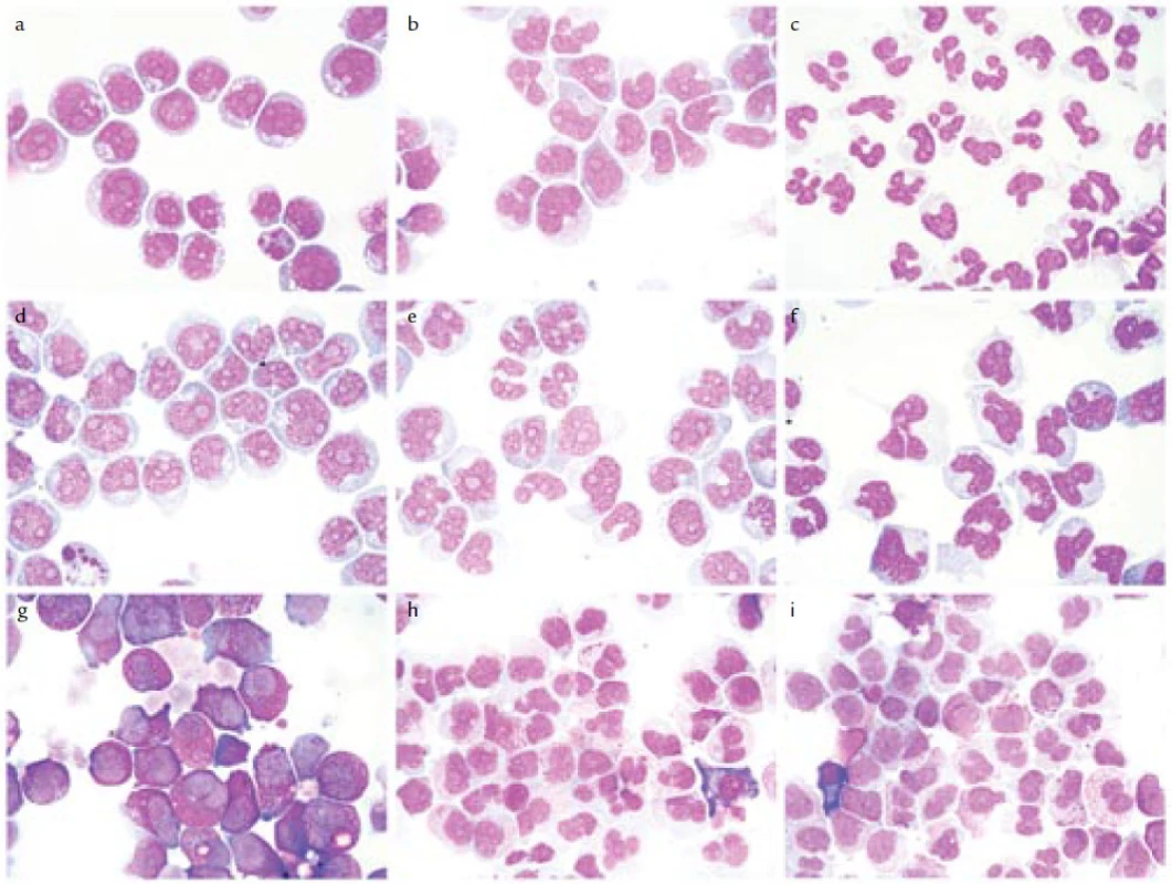Diferenciace leukemických buněk působením retinoidů in vitro. 
