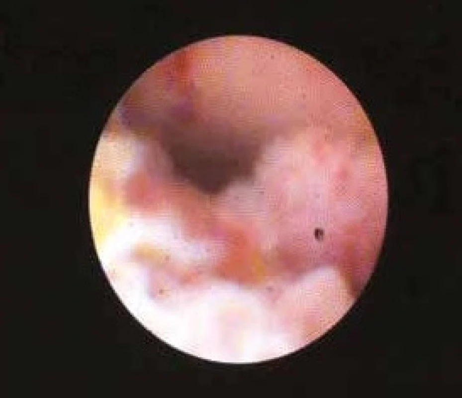Cholangioskopie Spyglass: polypoidní nádorová masa v terminálním úseku žlučovodu – histologicky adenom