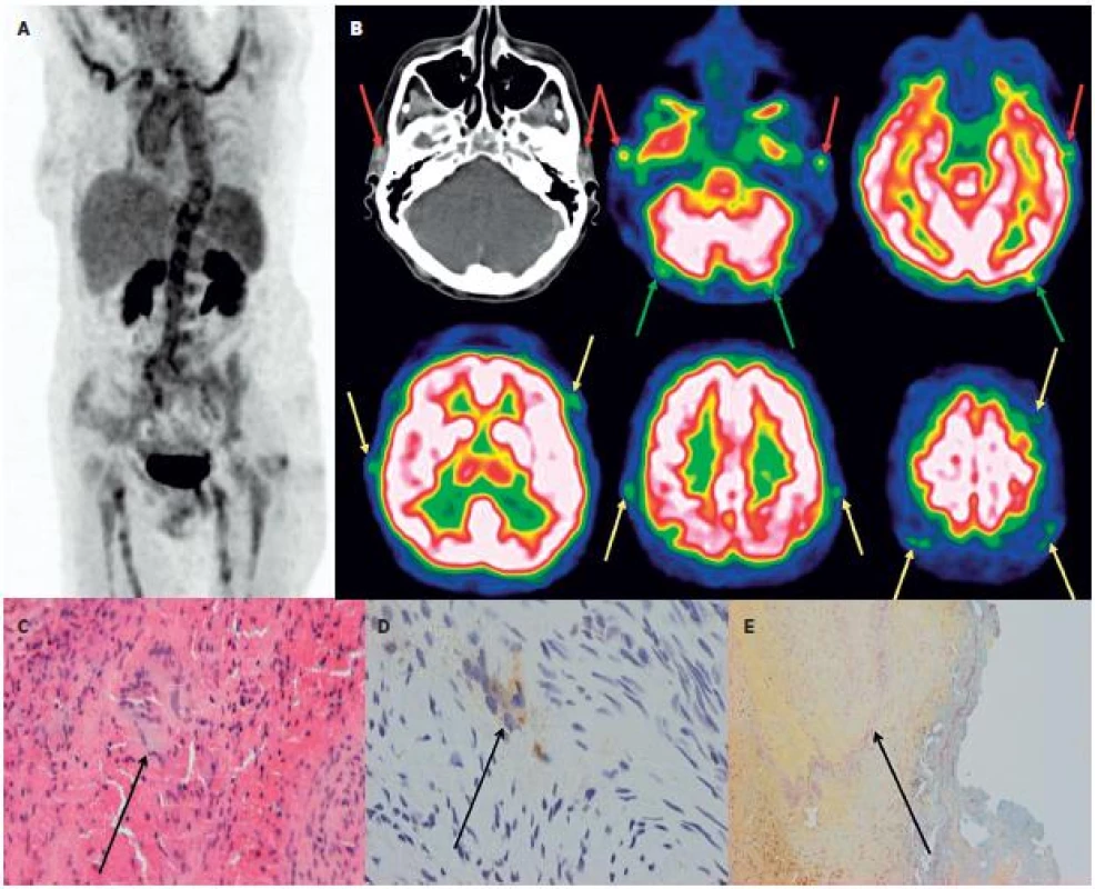 Kazuistika – žena 63 let. 3A Hybridní PET/CT vyšetření trupu PET MIP prokazuje u pacientky s „horečkou neznámého původu“ vysokou akumulaci FDG v aortě a velkých tepnách. 3B: Doplněné speciální snímání mozku detekovalo vysokou akumulaci FDG i ve spánkových tepnách (červené šipky), jejich frontálních a parietálních větvích (žluté šipky) i okcipitálních tepnách (zelené šipky). Histologické vyšetření z excize větve levostranné spánkové tepny prokázalo obrovskobuněčnou arteritidu.
(3C: HE, zv. 200x, označeny vícejaderné buňky, 3D: imunohistochemické vyšetření anti CD 68+, zv. 200x, označeny vícejaderné buňky, 3E: resorcin-fuchsin, zv. 100x, označen rozpad lamina elastica interna).