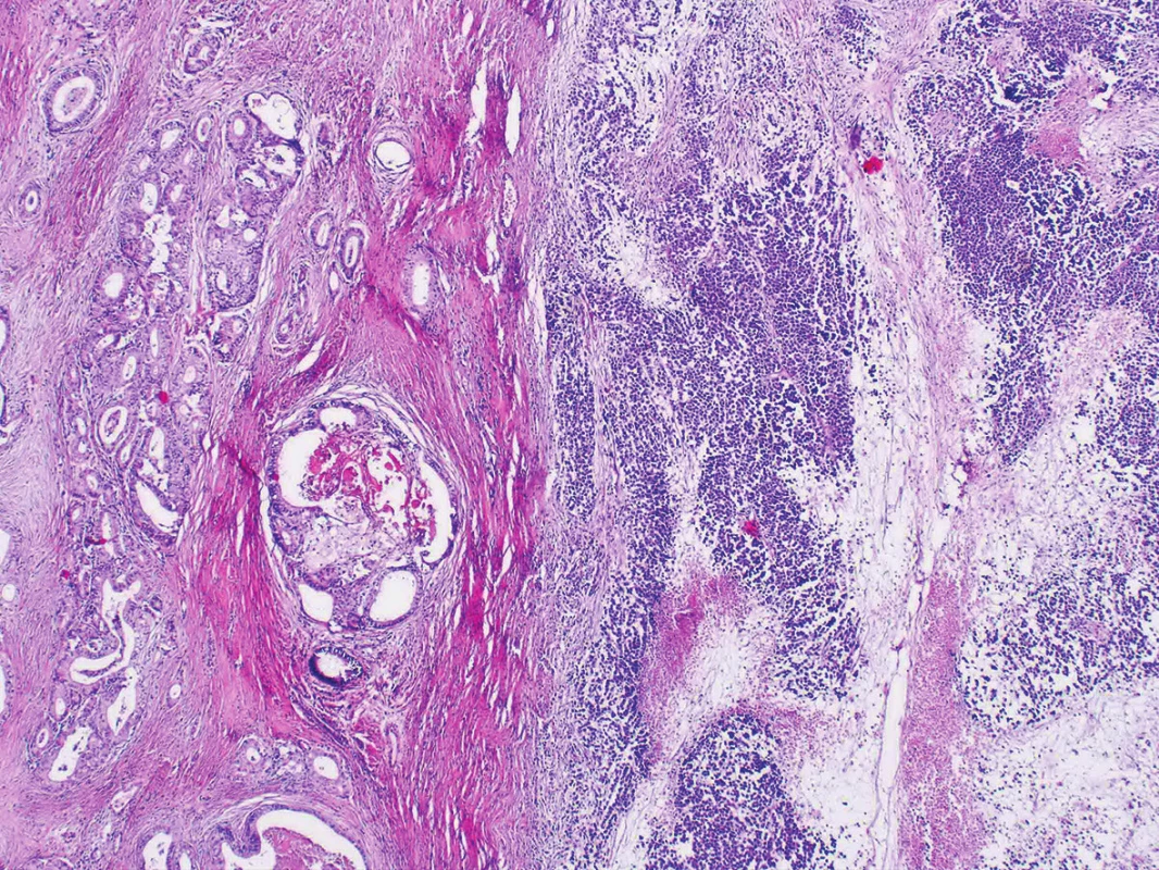 Dedifferentiated carcinoma with undifferentiated and well-differentiated components (H&amp;E, original magnification 40x).