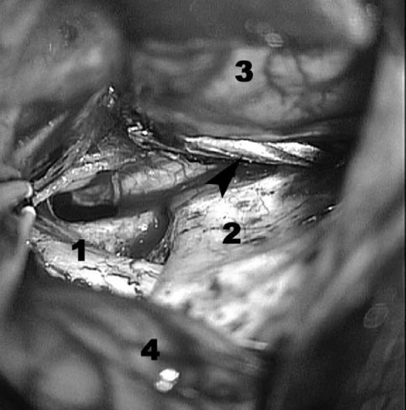 Peroperační verifikace hřebu šipka-hřeb, 1-chiasma opticum, 2-báze přední jámy lební. 3 čelní lalok, 4- spánkový lalok