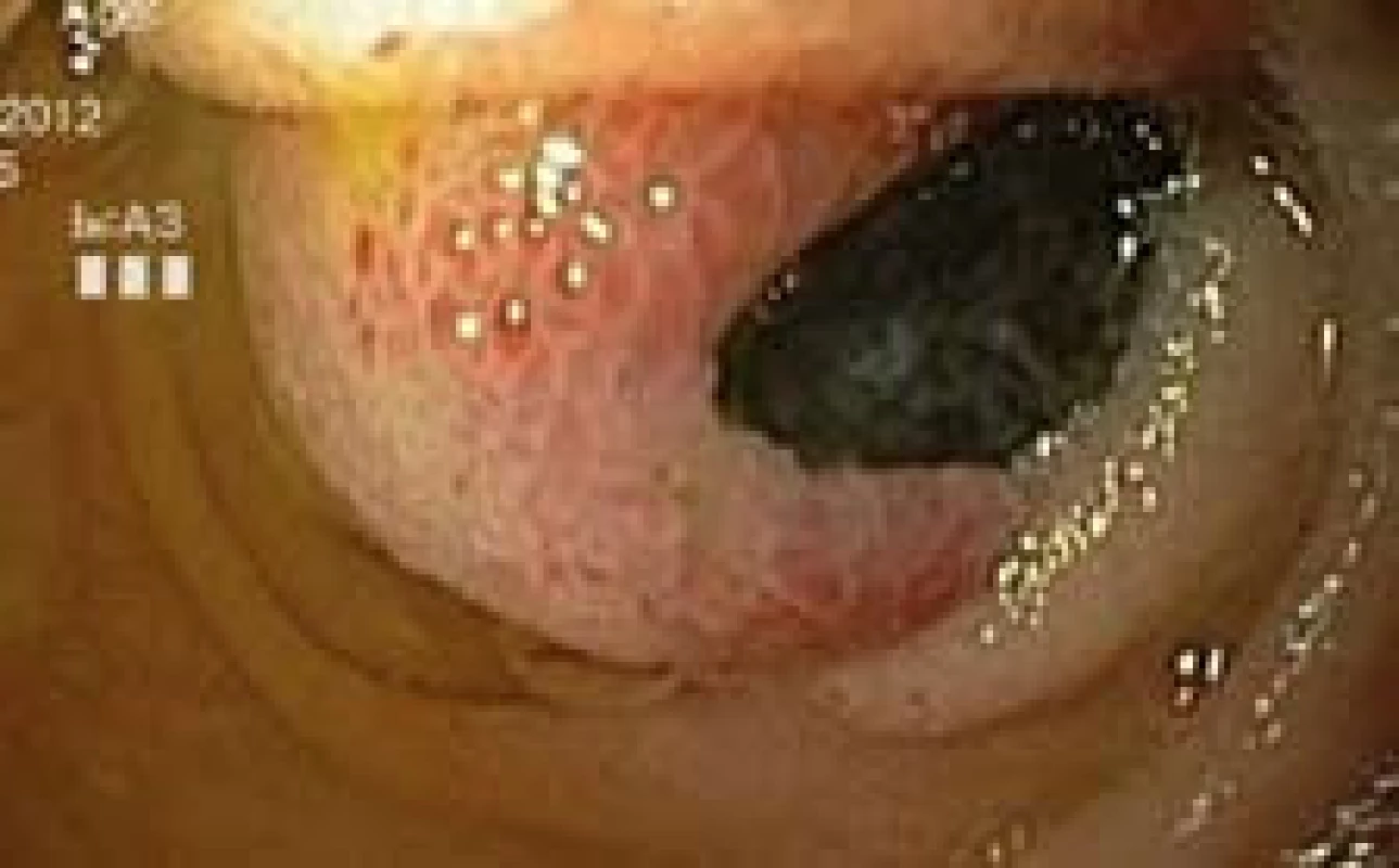 Exulcerovaný polyp jejuna, push enteroskopie.
Fig. 1. Ulcerated poylp of jejunum, push enteroscopy.