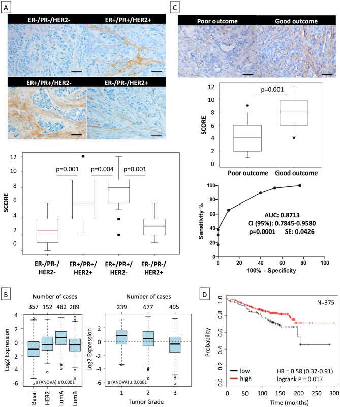 High asporin expression in human breast cancer matches with luminal-like tumor type and good patient outcome.